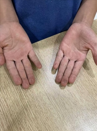 9歲小學(xué)生長(zhǎng)期拍煙卡，手部粗糙長(zhǎng)繭。受訪者供圖